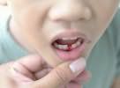 выпадение зубов