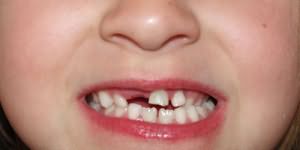 зубы выпадают у детей